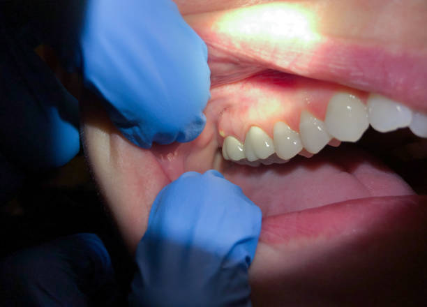 Best Emergency Dental Care for Sports Injuries in Bressler, PA